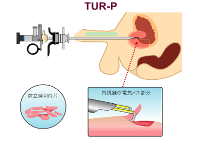 TUR-P(経尿道的前立腺切除術)