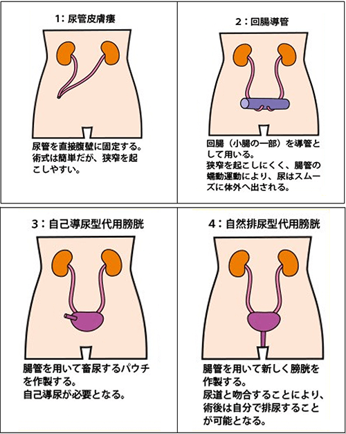 経尿道的膀胱腫瘍切除術