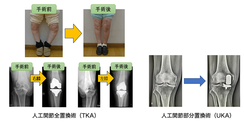 人工膝関節置換術（全置換、部分置換）